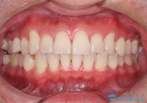 日々の歯磨き残しをPMTCで徹底的に除去の症例 治療後