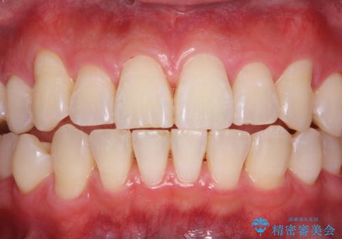 日々の歯磨き残しをPMTCで徹底的に除去の治療後