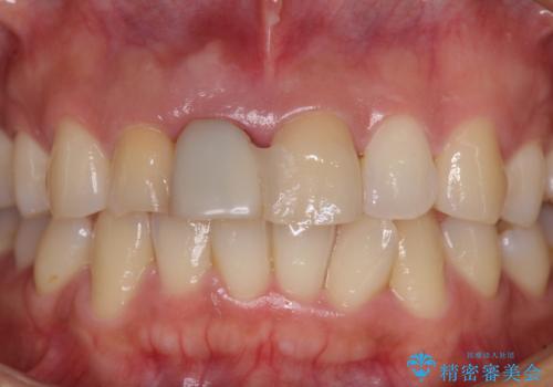 治療途中で放置した前歯 オールセラミックブリッジの治療前