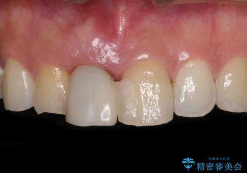 治療途中で放置した前歯 オールセラミックブリッジの治療前