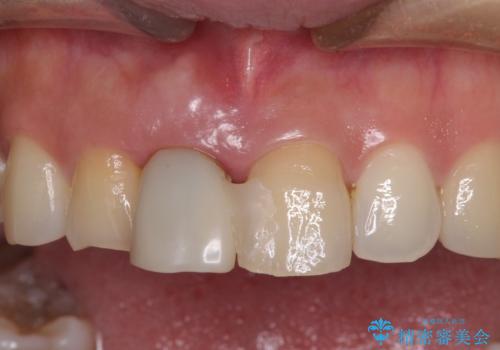 治療途中で放置した前歯 オールセラミックブリッジの治療前