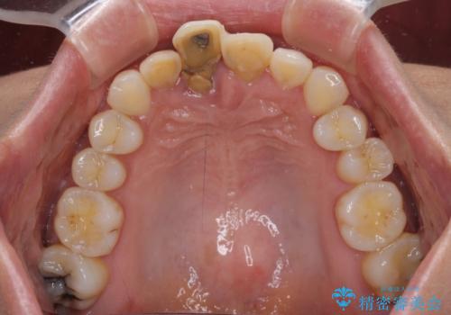 治療途中で放置した前歯 オールセラミックブリッジの治療前