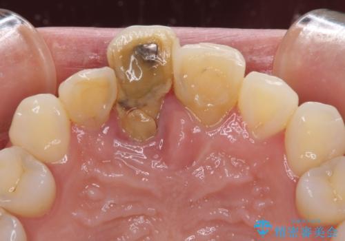 治療途中で放置した前歯 オールセラミックブリッジの治療前