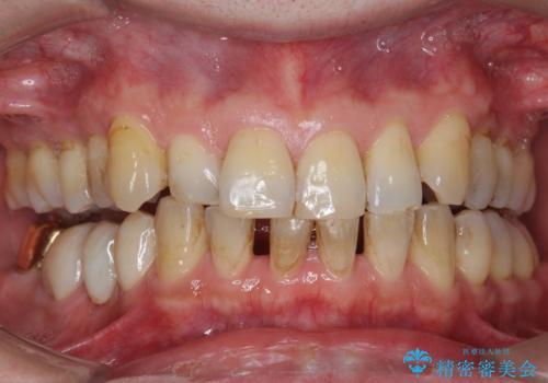 オフィスホワイトニングで歯の色を、白く口元を明るく爽やかに!の症例 治療前