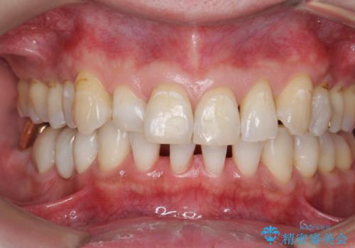 オフィスホワイトニングで歯の色を、白く口元を明るく爽やかに!の治療後