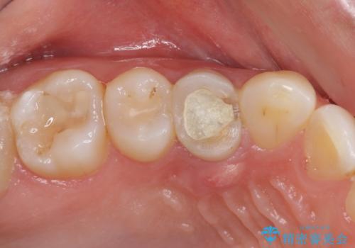 深い虫歯の歯を抜歯　目立つ小臼歯のインプラント治療の症例 治療前