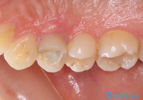 深い虫歯の歯を抜歯 目立つ小臼歯のインプラント治療の治療前