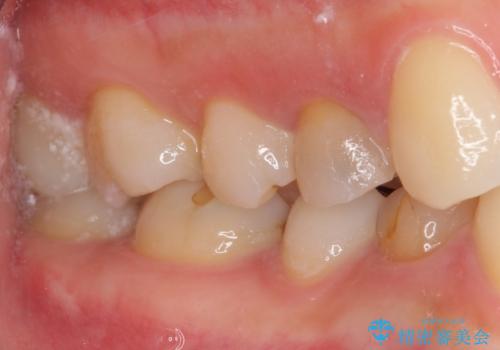 深い虫歯の歯を抜歯 目立つ小臼歯のインプラント治療の治療前