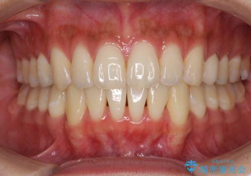 八重歯の再矯正 インビザラインでストレスなく矯正治療