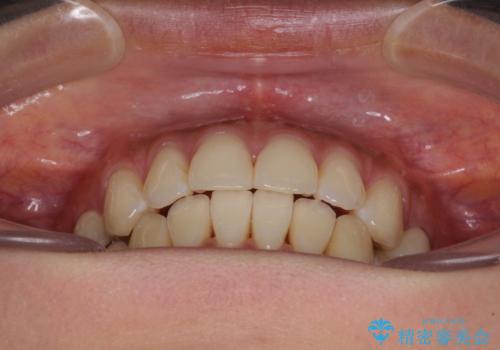 八重歯の再矯正　インビザラインでストレスなく矯正治療の治療後