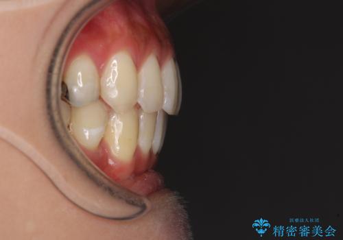 八重歯の再矯正 インビザラインでストレスなく矯正治療の治療後