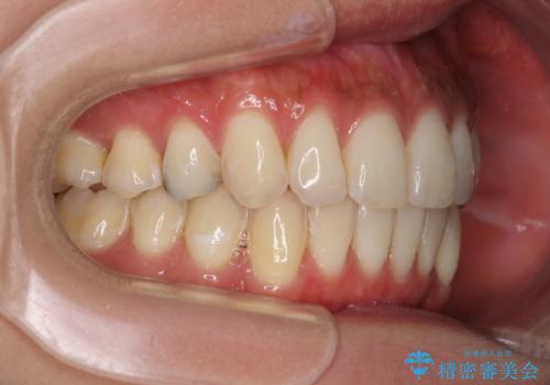 八重歯の再矯正 インビザラインでストレスなく矯正治療の治療後