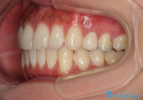 八重歯の再矯正 インビザラインでストレスなく矯正治療の治療後