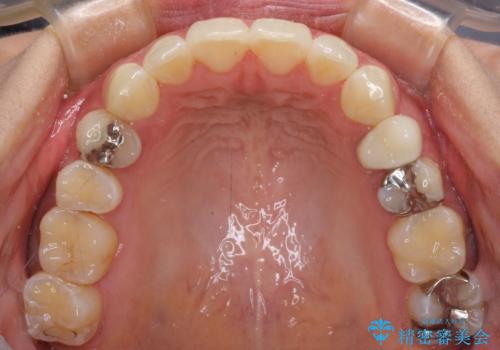 八重歯の再矯正 インビザラインでストレスなく矯正治療の治療後