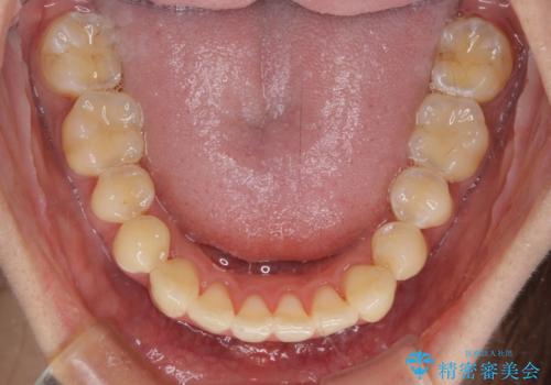 八重歯の再矯正 インビザラインでストレスなく矯正治療の治療後