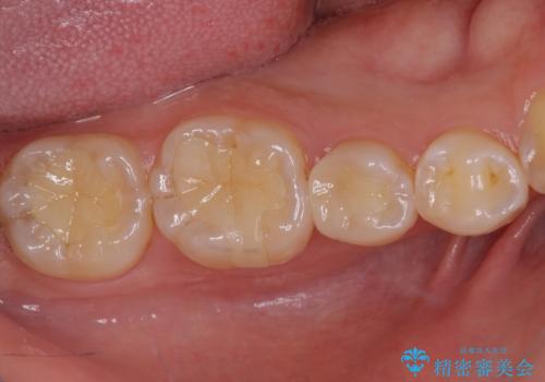 ディープバイトと叢生を解消 インビザライン矯正の治療後
