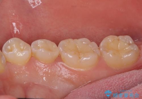 ディープバイトと叢生を解消 インビザライン矯正の治療後