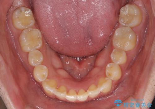 ディープバイトと叢生を解消 インビザライン矯正の治療後