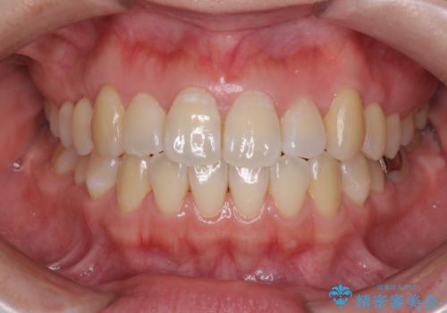 口元の突出感を改善　インビザラインによる非抜歯矯正