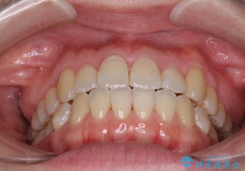 口元の突出感を改善 インビザラインによる非抜歯矯正の治療後