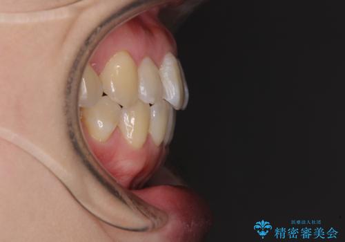 口元の突出感を改善　インビザラインによる非抜歯矯正の治療後
