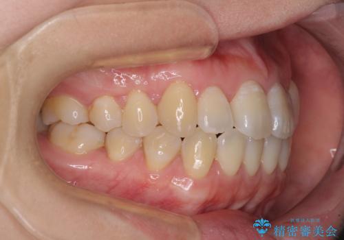 口元の突出感を改善 インビザラインによる非抜歯矯正の治療後