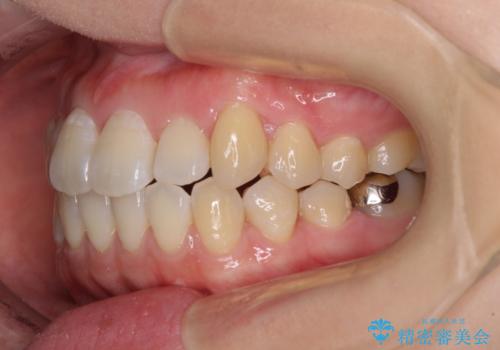 口元の突出感を改善 インビザラインによる非抜歯矯正の治療後