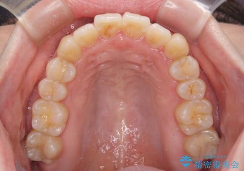 口元の突出感を改善　インビザラインによる非抜歯矯正の治療後