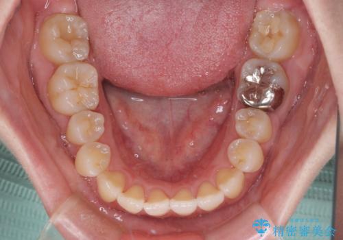 口元の突出感を改善 インビザラインによる非抜歯矯正の治療後