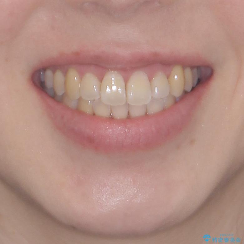 口元の突出感を改善　インビザラインによる非抜歯矯正の治療後（顔貌）