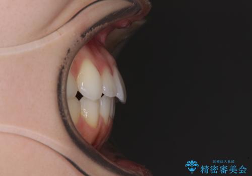 インビザライン・ライトにより後戻りの再矯正の治療後