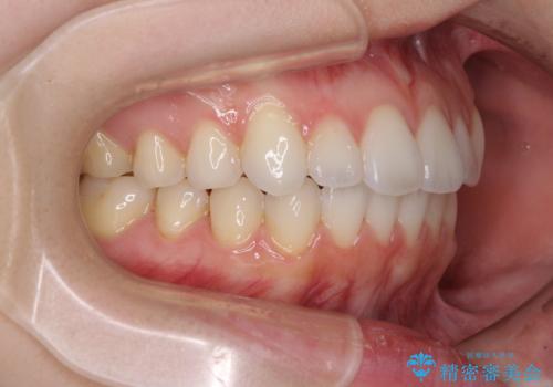 インビザライン・ライトにより後戻りの再矯正の治療後