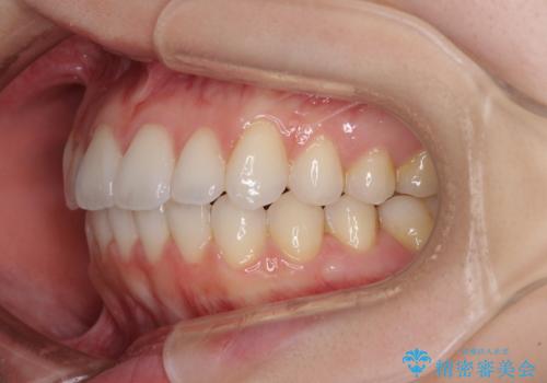 インビザライン・ライトにより後戻りの再矯正の治療後