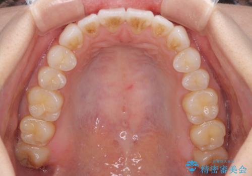 インビザライン・ライトにより後戻りの再矯正の治療後