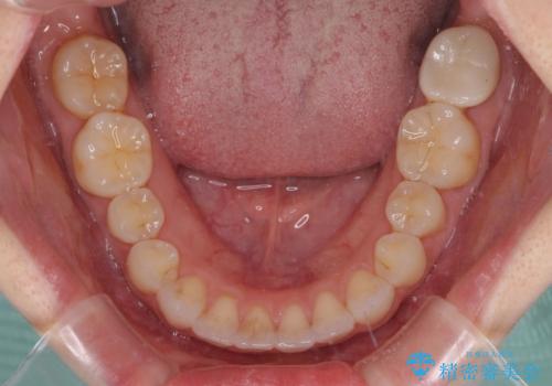 インビザライン・ライトにより後戻りの再矯正の治療後