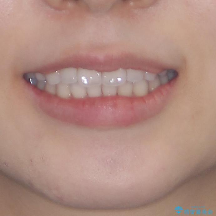 インビザライン・ライトにより後戻りの再矯正の治療後(顔貌)