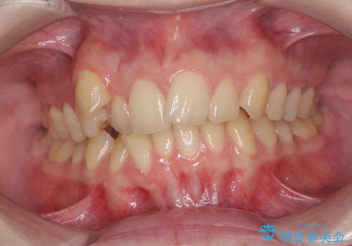 八重歯を短期間で改善 ワイヤー装置による抜歯矯正の治療前