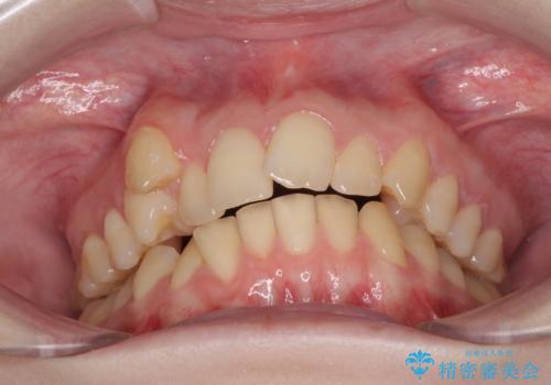 八重歯を短期間で改善 ワイヤー装置による抜歯矯正の治療前