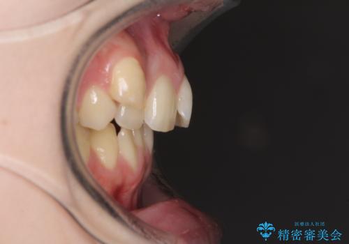 八重歯を短期間で改善 ワイヤー装置による抜歯矯正の治療前