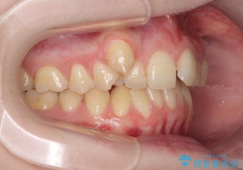 八重歯を短期間で改善 ワイヤー装置による抜歯矯正の治療前