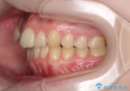 八重歯を短期間で改善　ワイヤー装置による抜歯矯正の治療前