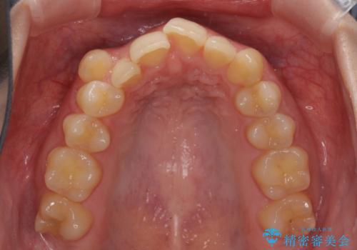 八重歯を短期間で改善 ワイヤー装置による抜歯矯正の治療前