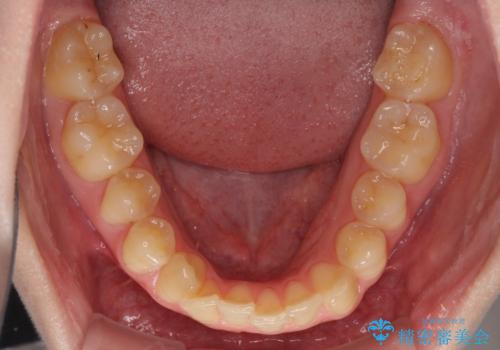八重歯を短期間で改善 ワイヤー装置による抜歯矯正の治療前