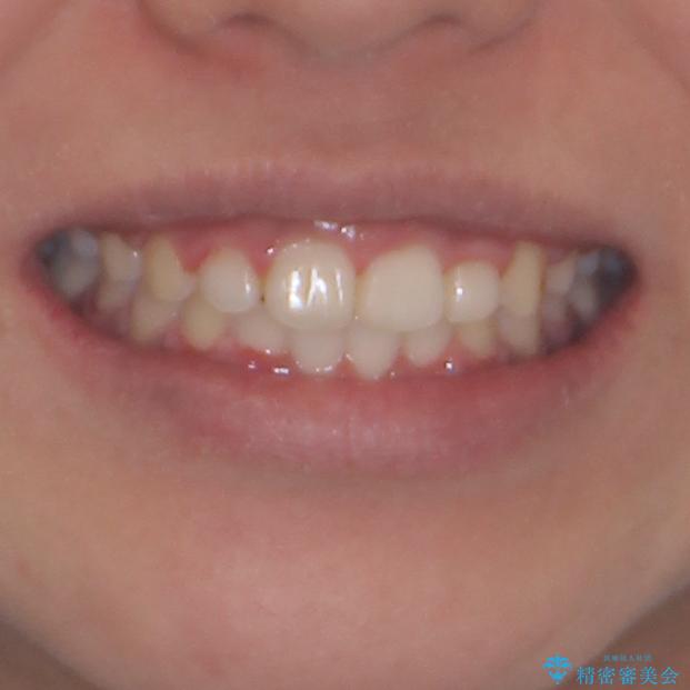 インビザラインが続けられない ワイヤー装置での矯正治療の治療後(顔貌)