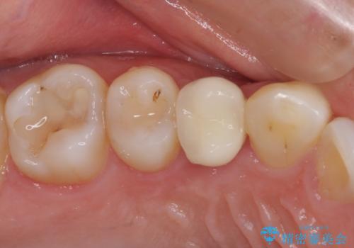 深い虫歯の歯を抜歯　目立つ小臼歯のインプラント治療