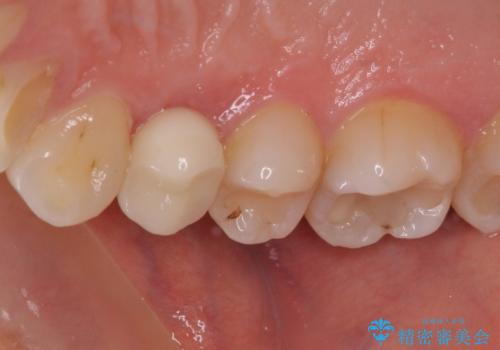 深い虫歯の歯を抜歯　目立つ小臼歯のインプラント治療の治療後