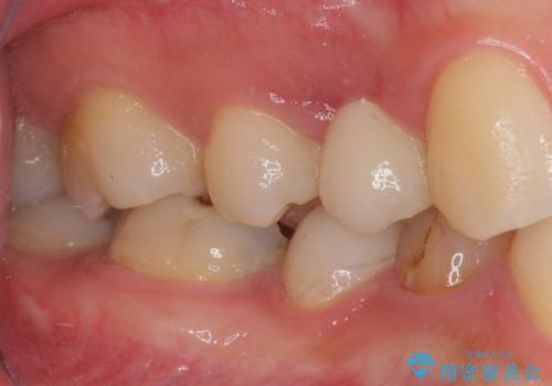 深い虫歯の歯を抜歯 目立つ小臼歯のインプラント治療の治療後