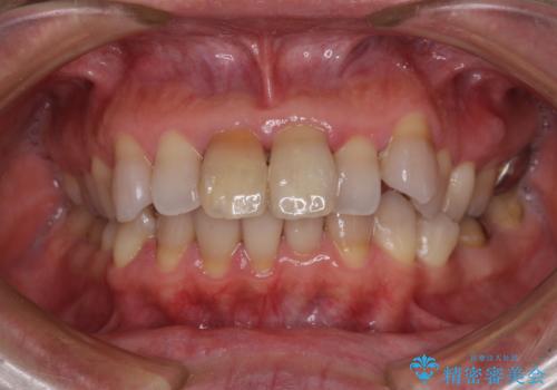 変色した前歯 オールセラミッククラウンにより審美歯科治療の治療前