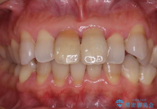 変色した前歯 オールセラミッククラウンにより審美歯科治療の治療前