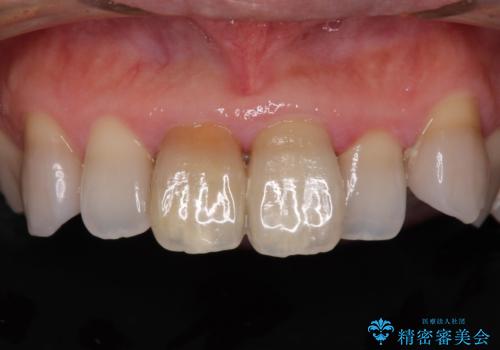 変色した前歯 オールセラミッククラウンにより審美歯科治療の症例 治療前